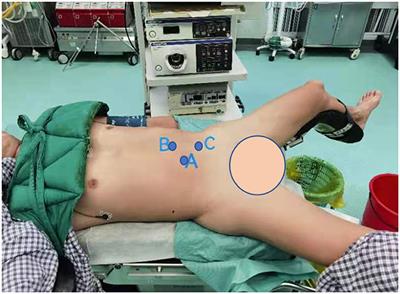 Transabdominal Laparoscopic Ureteroureterostomy With the Intraoperative Retrograde Ureteroscopy-Assisted Technique for Multiple Ureteral Polyps: A Single-Center 10 Years Experiences
